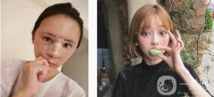 之前想了很久，由于實(shí)在不喜歡自己的鼻子，影響了自己的整體形象，所以來做