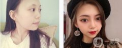 一直對自己的鼻子不是特別滿意，后來查了很多醫(yī)院才決定來這一家