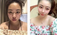 醫(yī)生說我的鼻子需要抬高鼻梁，然后縮小鼻子