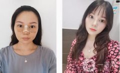 鼻梁很低，鼻翼很寬，從正面和側(cè)面看，這都是一個(gè)合適的塌鼻子
