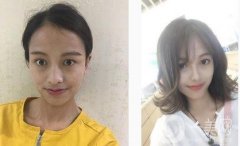 鼻子本身不太好看，一直想做鼻子，但是因為是個很糾結(jié)的人，一直糾結(jié)