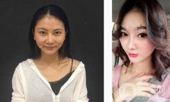 比如我的鼻子，我的鼻子，我的鼻梁都比較低，但是從正面看沒有問題，但是從
