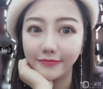 手術(shù)前鼻子不高，總覺得鼻子不好看
