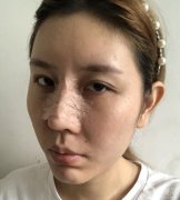 在網(wǎng)上查了很多隆鼻的資料，看到了各種鼻子類型