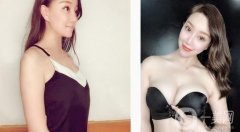 假體隆胸后一個月，現(xiàn)在有了漂亮性感的乳房，穿性感吊帶就沒壓力了