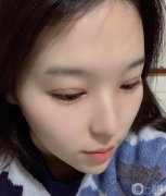 。手術(shù)前我是單眼皮純，沒(méi)有雙眼皮的痕跡，我一直夢(mèng)想如果我有雙眼皮