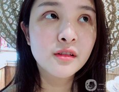 一定要特別注意雙眼皮的恢復期，說怎么剪雙眼皮的睫毛，怎么讓睫毛更長更密