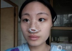 鼻子塌了，鼻子寬了，臉看起來扁扁的，不立體，一直想要個高鼻子