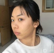線雕完第七天了，現(xiàn)在臉上的針眼還看得見，但是結(jié)痂了
