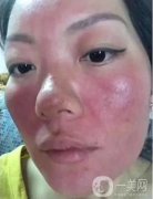 激素臉：癥狀、排毒與修復(fù)的探索