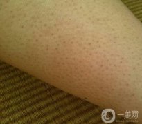 擺脫“雞皮膚”：理解、預(yù)防與調(diào)節(jié)