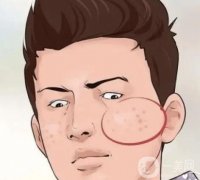 男士祛痘：戰(zhàn)斗痘疤，重拾自信