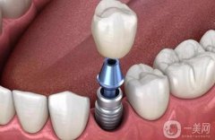 種植牙多少錢一顆價格表2023公布，了解種植牙費用及影響因素