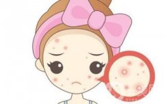痘痘肌的福音!揭秘致痘成分，讓你遠離痘痘困擾