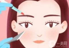 保定雙眼皮多少錢？埋線好還是割好？