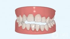 常德矯正牙齒一般多少錢？價目表2024版，靠譜醫(yī)院推薦