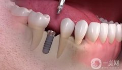 邵陽一顆種植牙要多少錢？收費價格表公布，一鍵查收