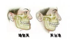 凸嘴正頜手術(shù)多少錢？手術(shù)時間、注意事項介紹詳細