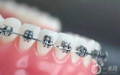巴南區(qū)牙齒矯正費用多少錢？正畸這五點你不得不知道