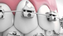 潮州牙齒矯正多少錢？收費(fèi)標(biāo)準(zhǔn)解答，附牙科機(jī)構(gòu)預(yù)選！