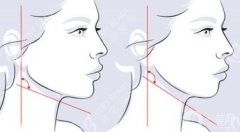 削顴骨要多少錢？全新價(jià)格費(fèi)用揭曉，機(jī)構(gòu)一鍵了解