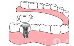 鄭州種植牙價(jià)格貴不貴？多少錢？全新口碑牙科醫(yī)院推薦