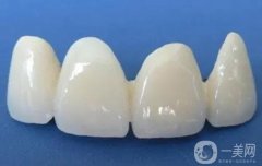 烏魯木齊烤瓷牙多少錢？烤瓷牙的適宜人群盤點