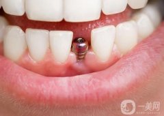 無錫種一顆牙價格多少錢？種植牙品牌怎么選？附五家靠譜醫(yī)院介紹