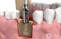 珠海種植牙價格表2024全新公布！植牙機構(gòu)+步驟一文全解析