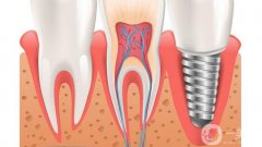 南昌種植牙多少錢一顆？價格費用概況解析，附高性價比醫(yī)院盤點