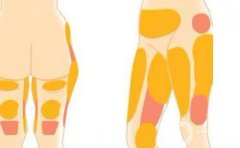 減肥抽脂術(shù)要多少錢？效果如何？盤點四家口碑醫(yī)院了解一下！