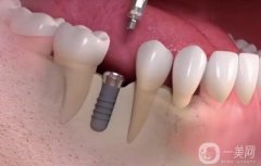 佛山種牙多少錢一顆??？價格費用詳細(xì)_靠譜醫(yī)院測評3家