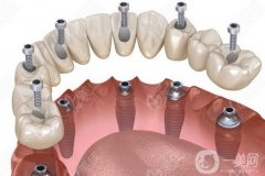 三亞種一顆牙多少錢？種植牙步驟和階段時間一文解答