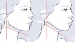 磨骨下頜角要多少錢(qián)？下頜角磨骨手術(shù)步驟、醫(yī)院這里了解！