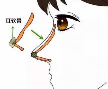肋骨隆鼻多少錢(qián)？肋骨隆鼻和耳軟骨哪個(gè)好？醫(yī)院點(diǎn)評(píng)
