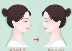張軍醫(yī)生隆鼻案例分享，專家資料介紹、價格收費標(biāo)準一覽