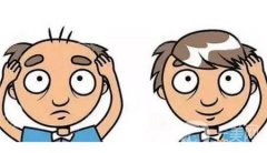 四級(jí)脫發(fā)大概需要多少