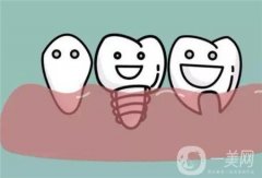 上海醫(yī)院種植牙一顆多少錢