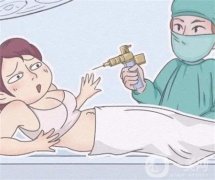 抽脂手術(shù)是否會反彈？術(shù)后何時能見效