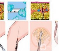 抽脂瘦大腿有什么副作用