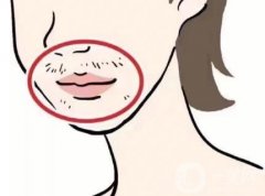 超冰脫毛做幾次有效果