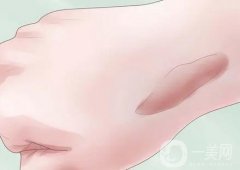 點陣激光祛疤需要多長時間才能見效