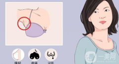 副乳切除術(shù)有哪些風險？會影響淋巴嗎