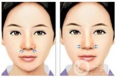 貴族手術(shù)有什么效果和特點