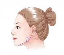 重慶磨骨整形價(jià)格