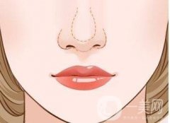 鼻部整形手術(shù)的恢復(fù)過程是怎樣的呢？