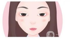 開外眼角會(huì)出現(xiàn)疤痕嗎？如何護(hù)理
