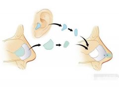 鼻頭縮小后如何快速消腫