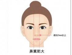 鼻翼內(nèi)切的切口在哪里