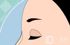 不同的鼻翼缺損的修復(fù)方法